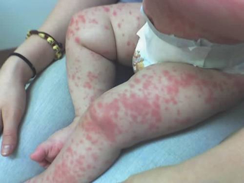 fiebre escarlata en los niños síntomas fotos