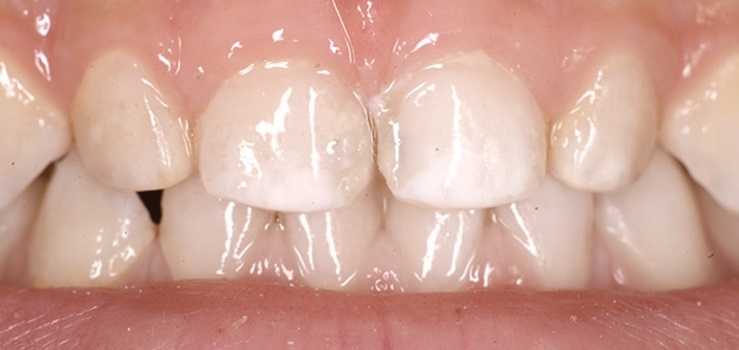 Cómo lidiar con manchas blancas en los dientes
