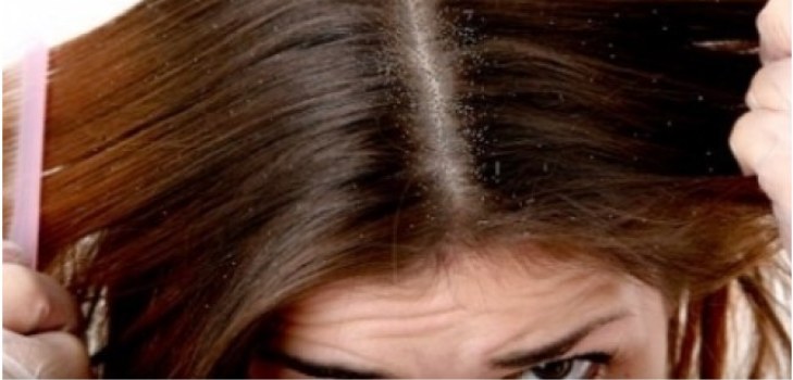 cabello con caspa