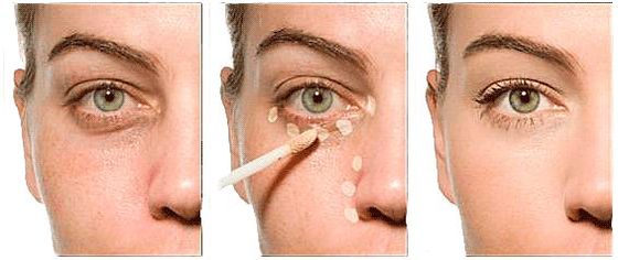 Maquillaje permanente para ocultar hematomas debajo de los ojos