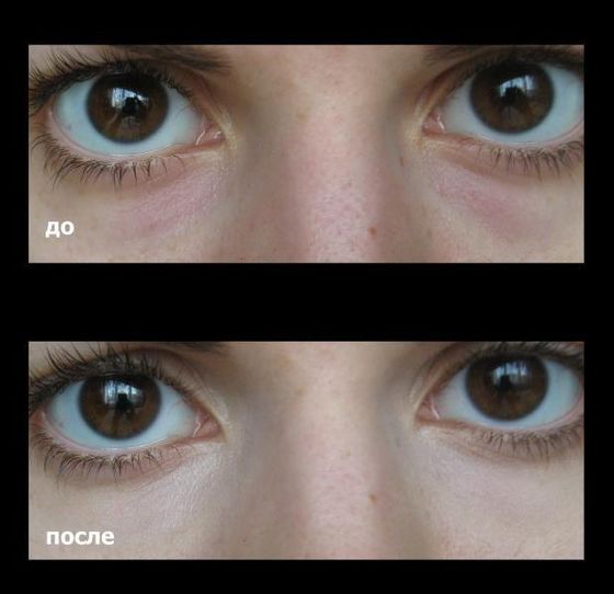 Maquillaje permanente para ocultar hematomas debajo de los ojos