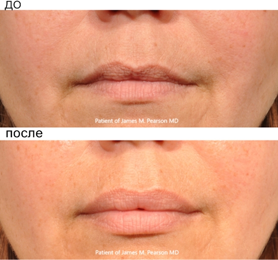 Plastia contorno de labios