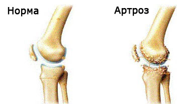 Tratamiento de la artrosis popular de la articulación de la rodilla
