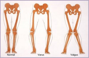 Tratamiento de la artrosis popular de la articulación de la rodilla