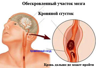 Tratamiento de la aterosclerosis con remedios caseros