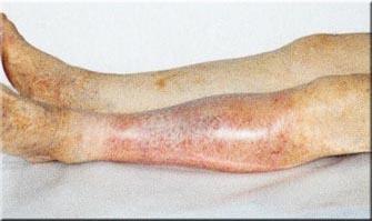 Tratamiento de la aterosclerosis con remedios caseros