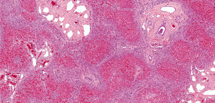 ¿Qué es fibrosis? Síntomas, fotos, tratamiento