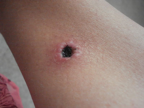 ¿Qué es una fístula? Síntomas, fotos, tratamiento de la fístula