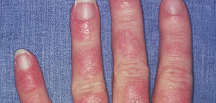 ¿Qué es el lupus? Síntomas y causas de la enfermedad