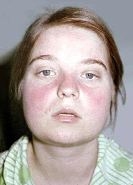 ¿Qué es el lupus? Síntomas y causas de la enfermedad