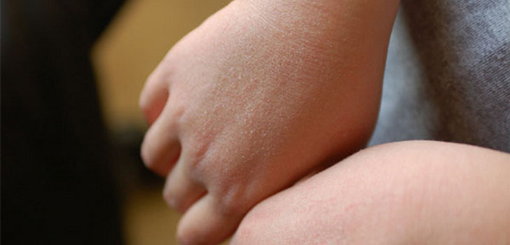 Nos deshacemos del enrojecimiento y la aspereza en las manos del niño
