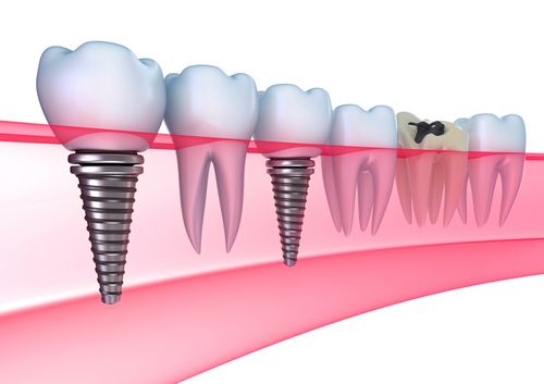 ¿La implantación dental es un lujo o una necesidad? 