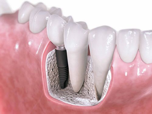¿La implantación dental es un lujo o una necesidad? 