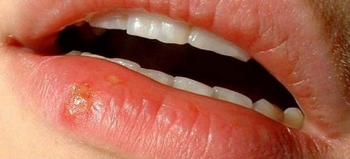 recetas para tratar los resfriados en los labios