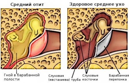¿Cómo tratar la otitis en el hogar?