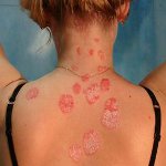 Cómo tratar la psoriasis? Cómo tratar la psoriasis?
