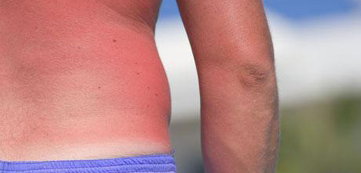La piel está chamuscada al sol. ¿Qué debería hacer? Recetas, máscaras, consejos