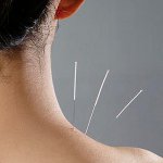 Tratamiento con acupuntura Tratamiento con acupuntura