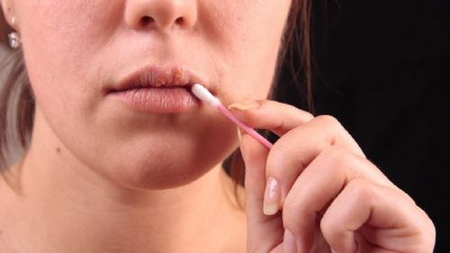 Maneras efectivas para tratar los resfriados en los labios