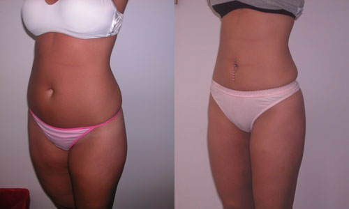 Liposucción del abdomen y los muslos: comentarios, fotos antes y después