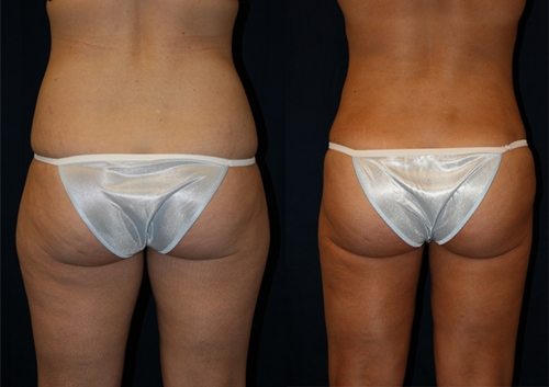 Liposucción del abdomen y los muslos: comentarios, fotos antes y después