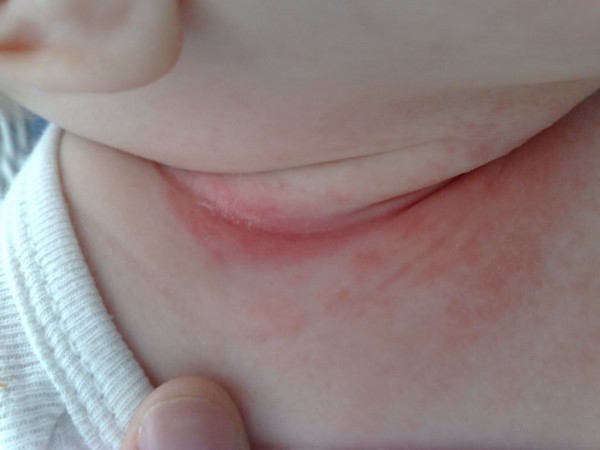 ¿Ha habido una erupción en el cuello de un adulto o un niño? Los principales métodos de tratamiento y prevención de la erupción cervical