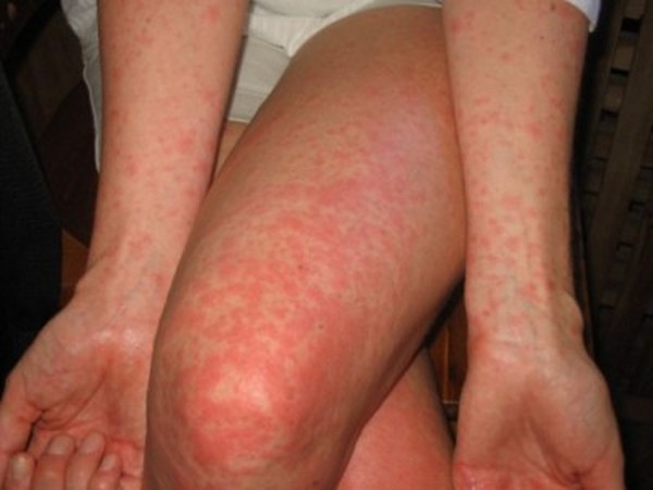 Erupciones en adultos: fotos, las causas de erupciones y consejos para el tratamiento de erupciones cutáneas
