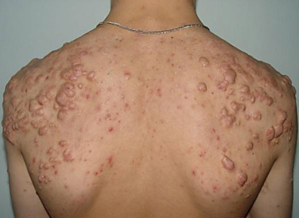 Erupciones en adultos: fotos, las causas de erupciones y consejos para el tratamiento de erupciones cutáneas