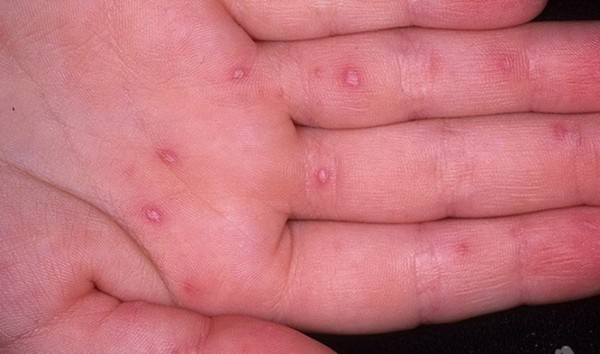 Erupciones en adultos: fotos, las causas de erupciones y consejos para el tratamiento de erupciones cutáneas