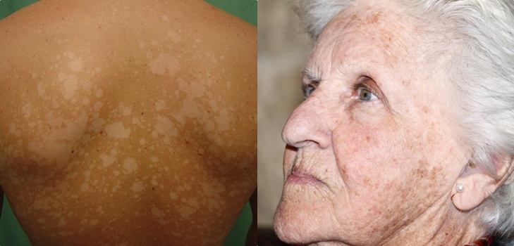 En la piel un peeling