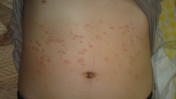 En la piel un peeling